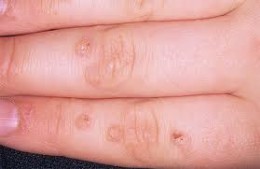 warts